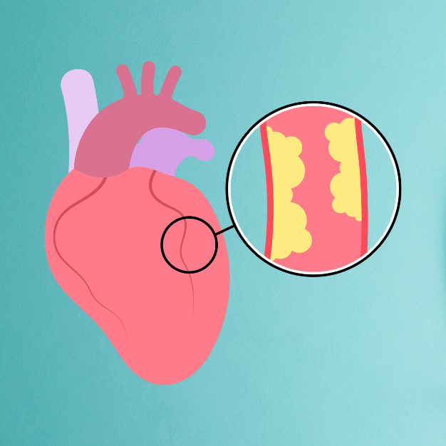 Atherosclerosis