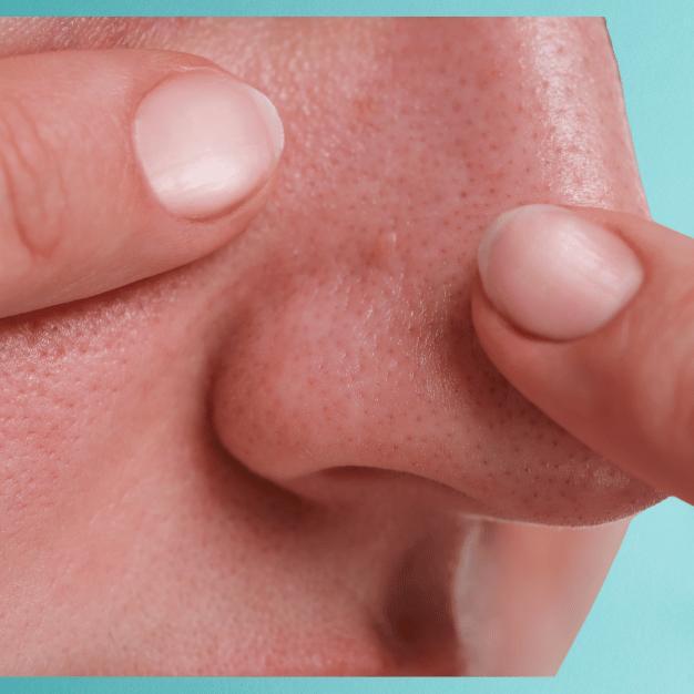 Blackheads & Whiteheads