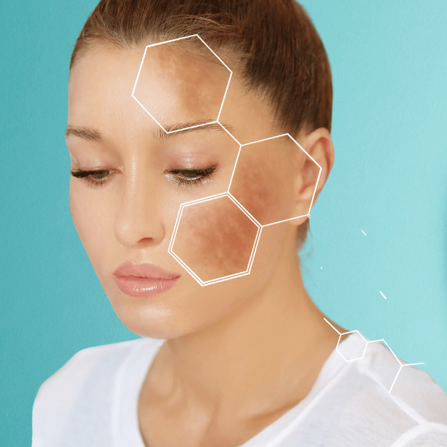 dark spot and pigmentation