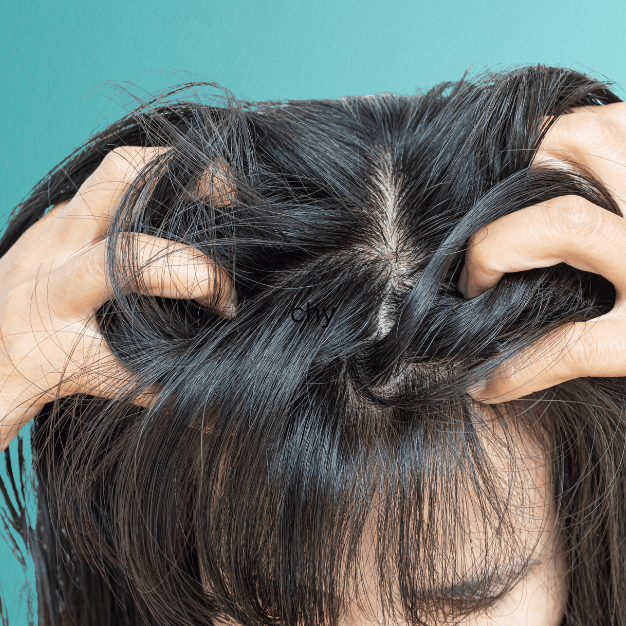 Itchy Scalp Relief