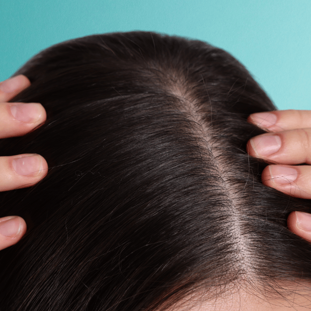oily scalp